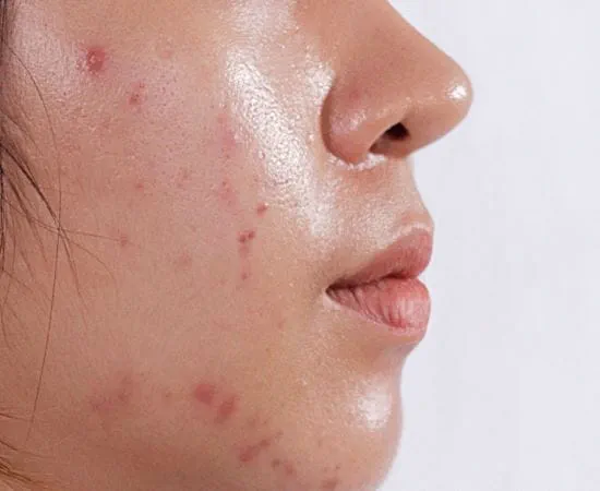 Tratamiento facial Balance control de grasa