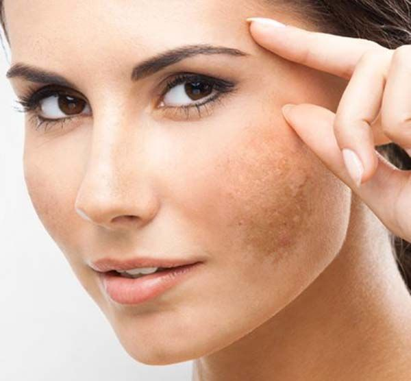 Tratamiento facial Lámina para pigmentaciones